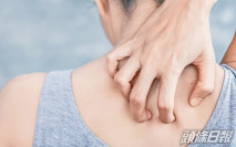 【健康Talk】銀屑病女性困擾較嚴重 放下工作防止惡化