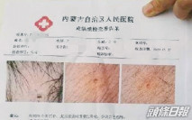多名幼童身上現針眼校長被免職 母公司旗下幼園虐童頻發