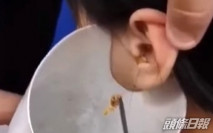 台幼童疑弱聽求診 病因竟是2cm「巨型耳屎」