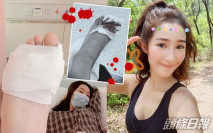 激動到發燒被送去做檢測 吳嘉儀鎅刀插爆腳入院