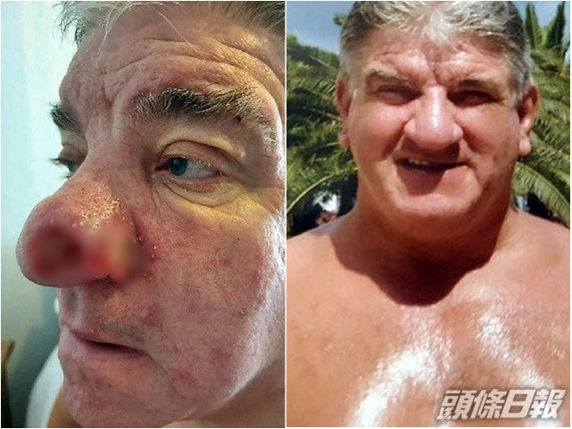 食用油當太陽油搽,終要切除鼻孔面留大窿。網圖