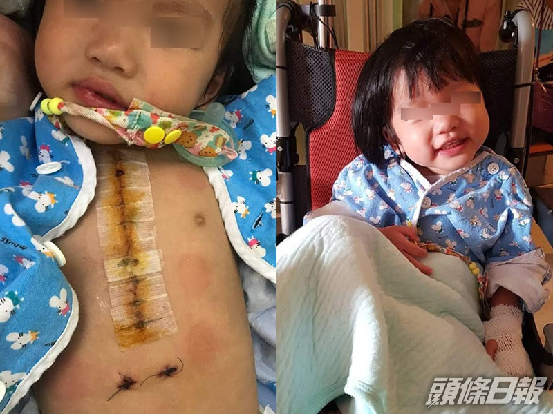 2歲女兒已經做過2次大手術。網圖
