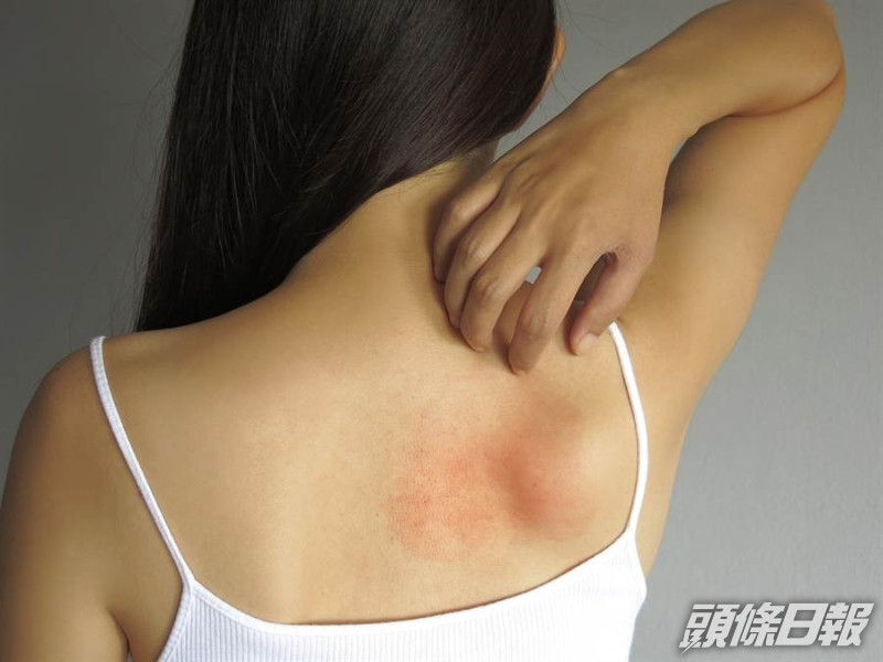 不論大人、小孩身上冒出一粒粒又熱又癢的痱子,都會感覺不舒服。