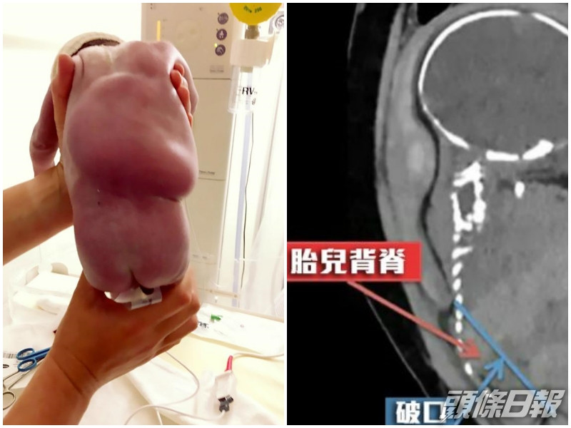 雖然嬰兒的背脊因而腫脹,但幾小時後已慢慢回復正常。網圖