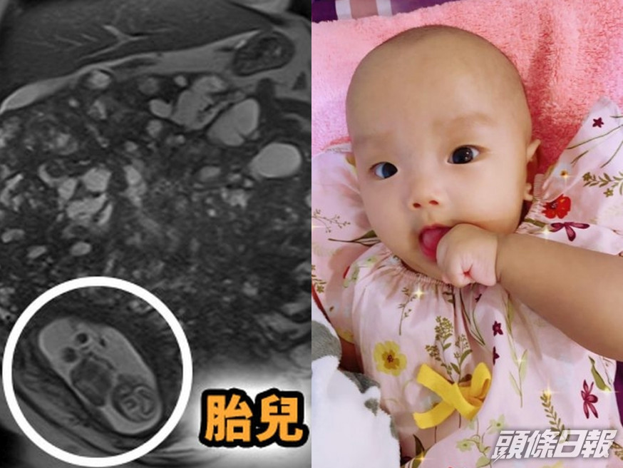 台灣一名孕媽子宮長巨型肌瘤塞滿全腹,更曾懷疑是惡性腫瘤,但她堅持捱至35週剖腹產,幸母子平安。(網圖)