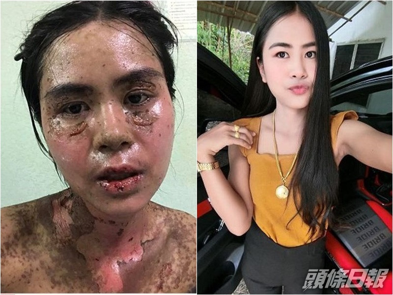 凱可涵因牙痛,自行服食止痛藥後出現過敏,全身脫皮疼痛,要送院治理。事主 Facebook