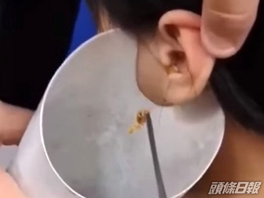 男童聽力出問題求診,醫生夾出巨型耳垢。(網圖)
