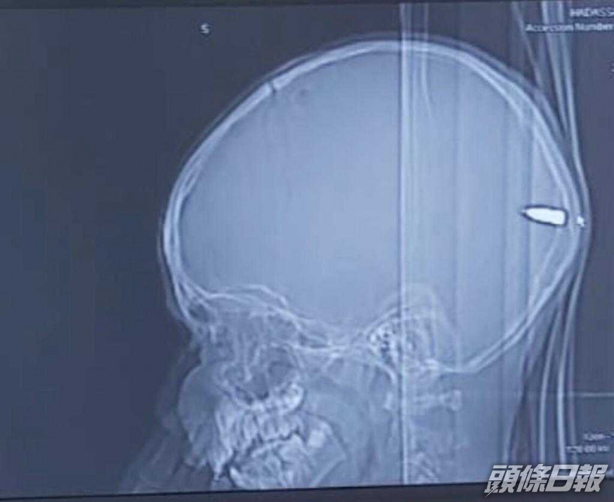 求醫才發現男童腦後顱骨位置卡住一顆子彈。網圖