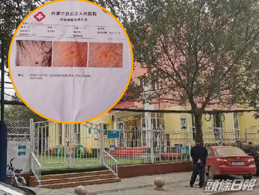 內蒙一間幼兒園多名孩童身上現針眼,警方將三名涉事老師刑拘。(網圖)