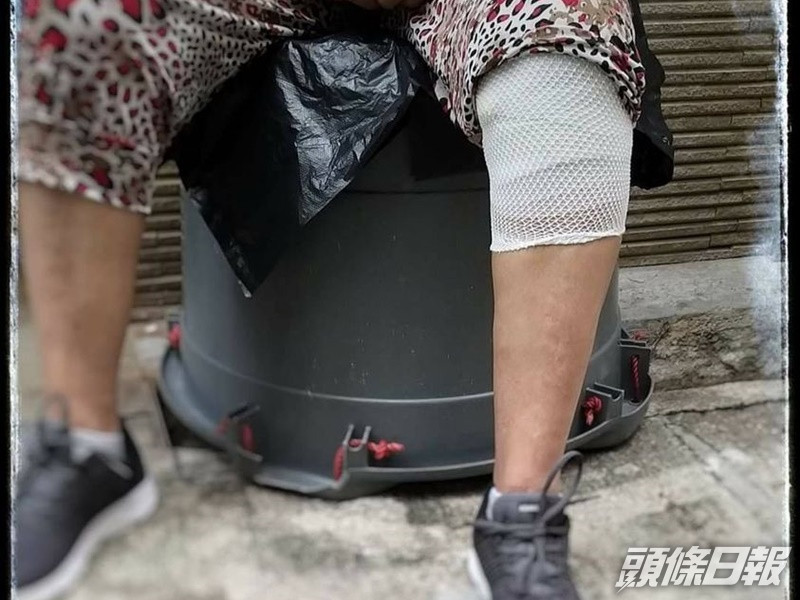 煥姐(化名)講述受傷經歷,她小腿上有一條約有五吋長的疤痕。「拾平台」fb圖片
