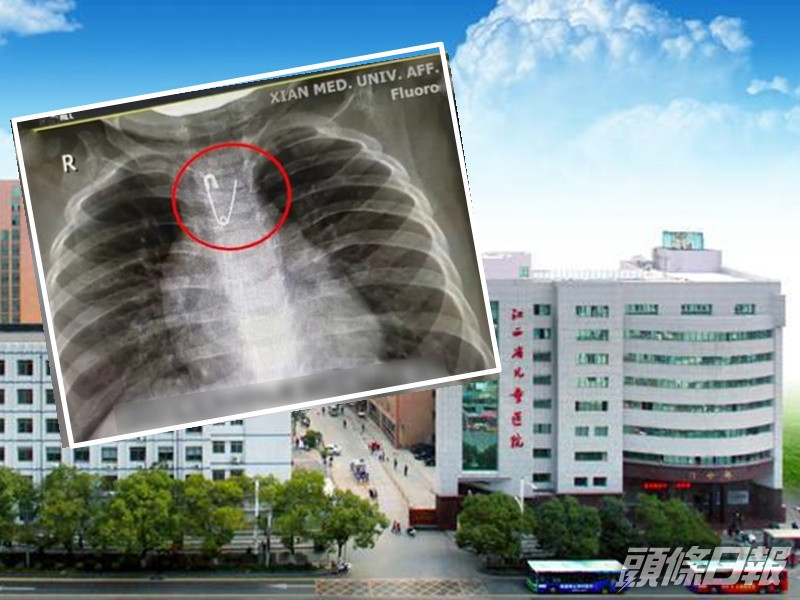 陝西西安上月亦曾發生有嬰兒吞下扣針事件。