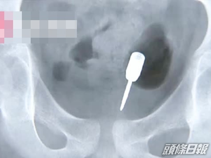 飛鏢。網圖
