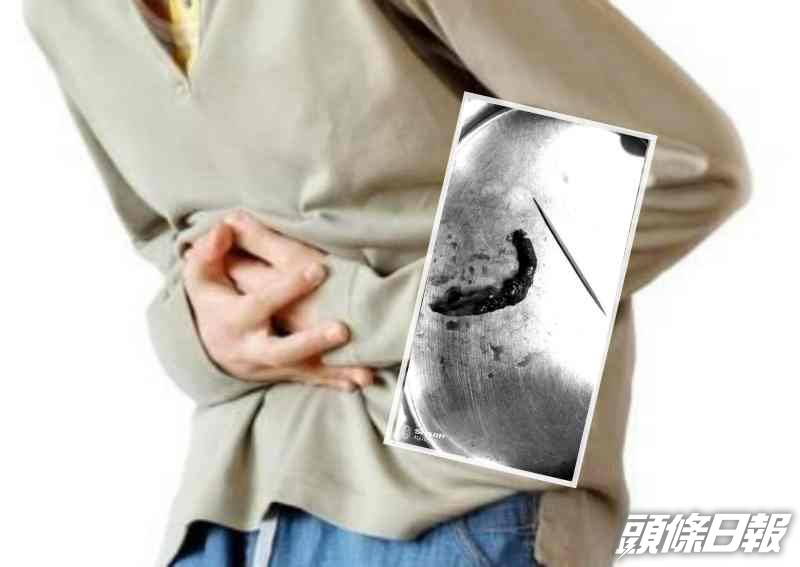 經了解,這3名病人都是在酒後誤吞牙籤。網圖