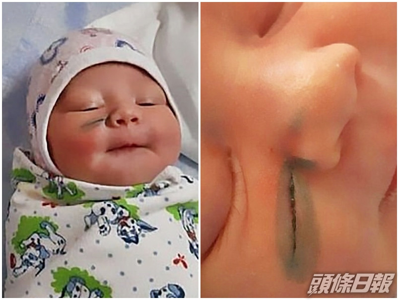 俄羅斯一名新手媽媽剖腹生產後,發現女兒的臉上有一道長約3厘米的傷口。網圖