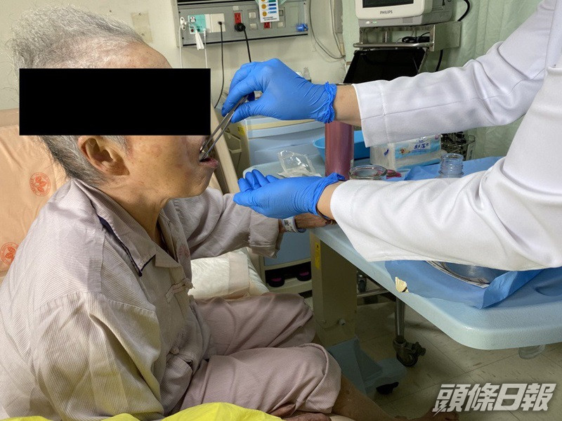 婆婆服用口服微菌叢植入治療術法醫治腸道病。台灣榮總圖片