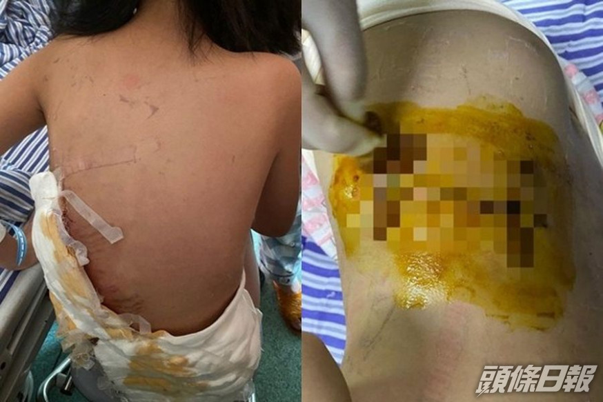 女童遭洛威拿犬咬至重傷。 網圖
