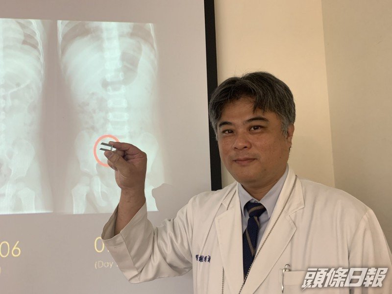謝明諭指,嬰幼兒誤食異物,觀察期最多是4個星期。網圖