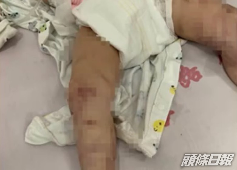 黃男童遭親生母親虐打,滿身傷痕,被送入深切治療部搶救。網圖