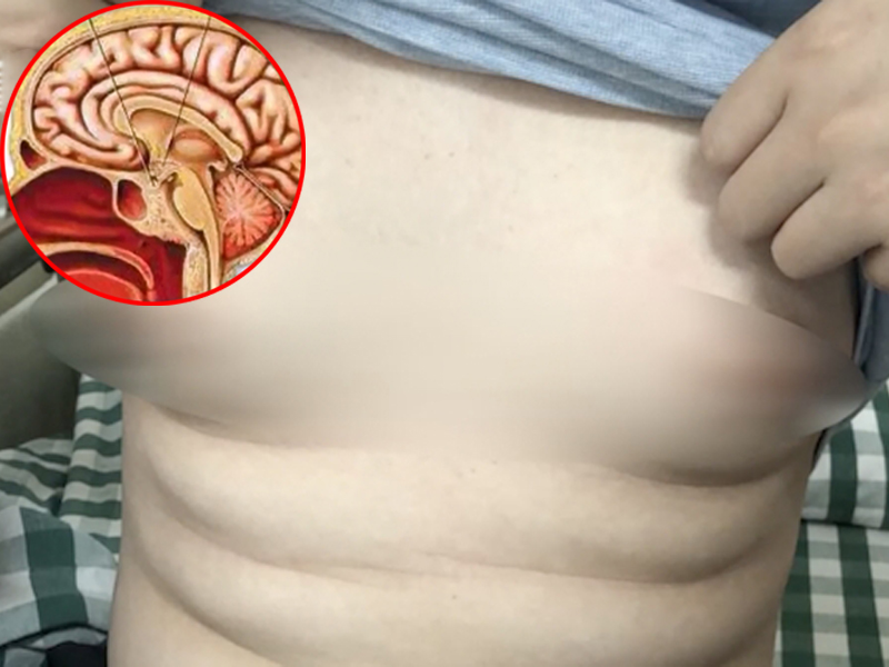 25歲男子胸部腫脹飆乳汁,竟因腦部垂體長瘤。(網圖)