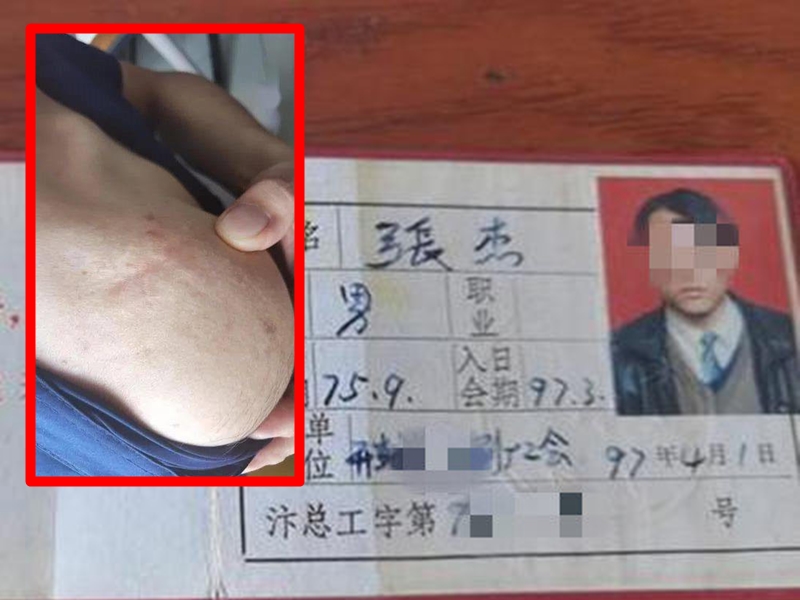 張杰出示當年的工作證及其受傷的傷疤。 網圖