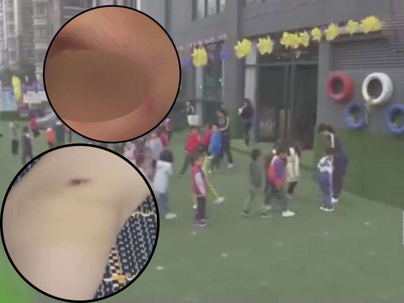 涉事幼稚園的家長,搜集到了一些幼兒瘀青、傷痕的照片。(網圖)