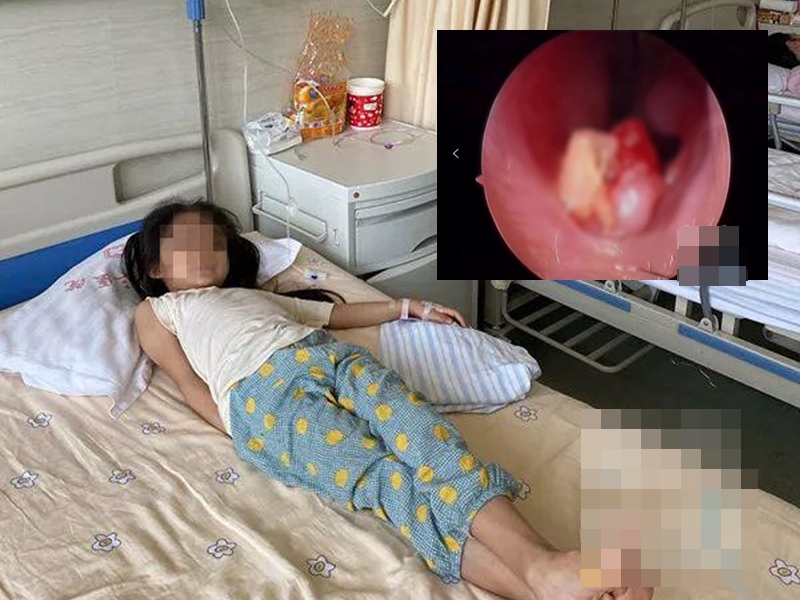 醫生將女童鼻內的牙齒完整拔出。 網圖