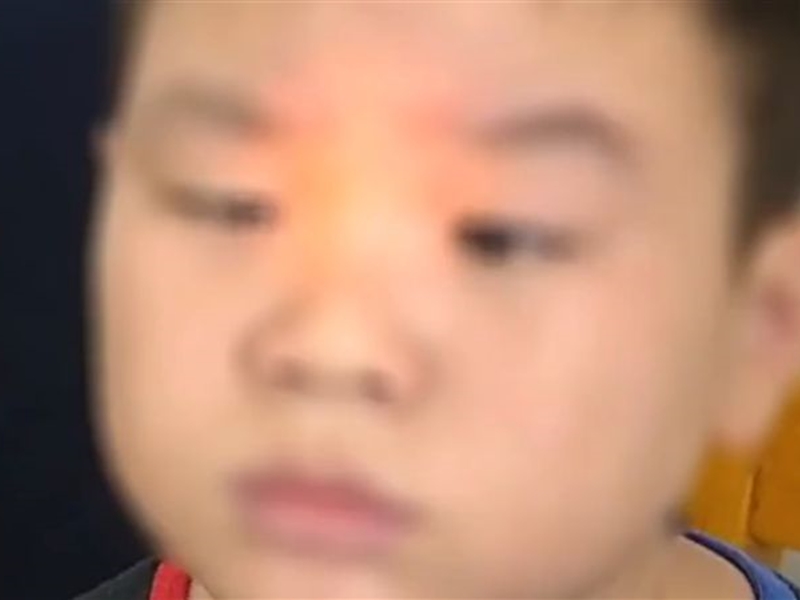 合肥一名9歲男童,因沉迷玩手機,導致雙眼變成「鬥雞眼」。影片截圖