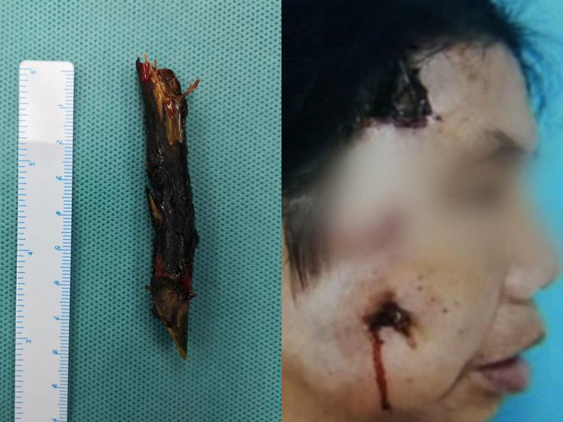 女子右臉流膿,整個爛掉,她面部竟拔出兩年前意外插入的樹枝,足有8cm長。(網圖)