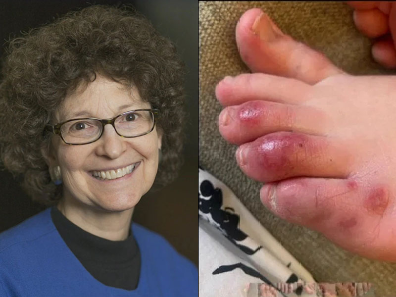 美國兒童皮膚科權威Amy Paller博士近日指出,腳趾出水痘或紅腫塊可能是無症狀新冠病毒兒童患者的感染跡象。(網圖)