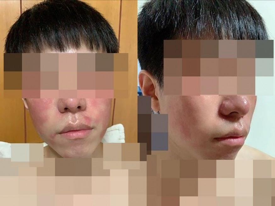 男友吃完蝦後,臉部過敏紅腫。「爆怨公社」FB圖片