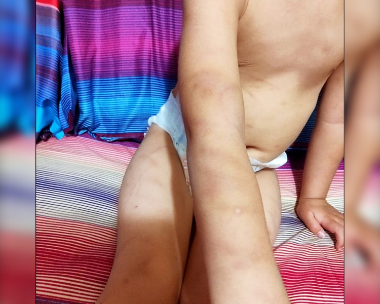 男童被父親用衫架打得全身瘀青。