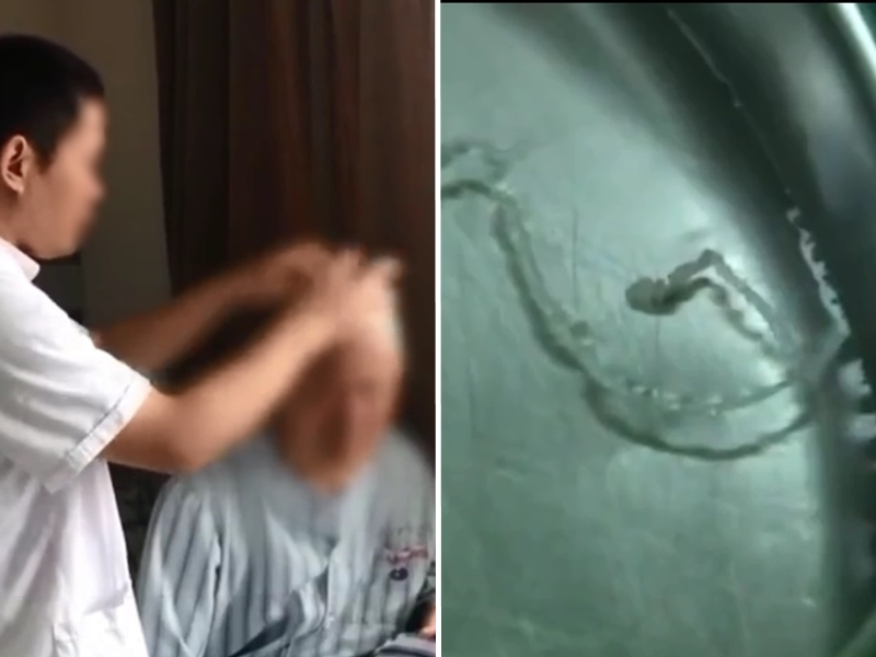 醫生指男子是遭到裂頭蚴寄生蟲感染,透過手術將他頭顱內的10厘米活蟲取出。 影片截圖