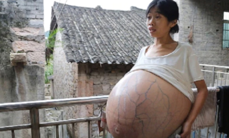 黃國嫻的腹部脹起變巨球,感嘆每晚僅能坐著在床上睡覺。 微博圖