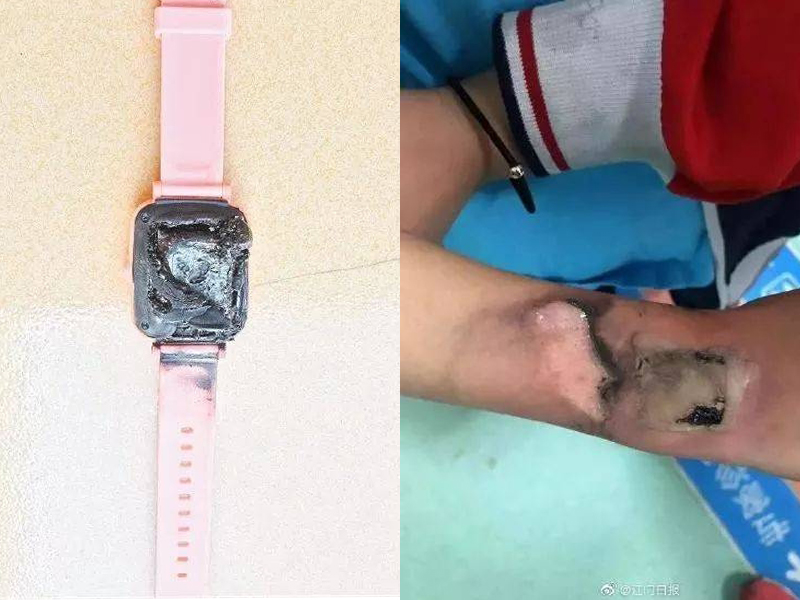 廣東一名小學生的電話手錶突然冒煙自燃,手腕被燙傷。(網圖)
