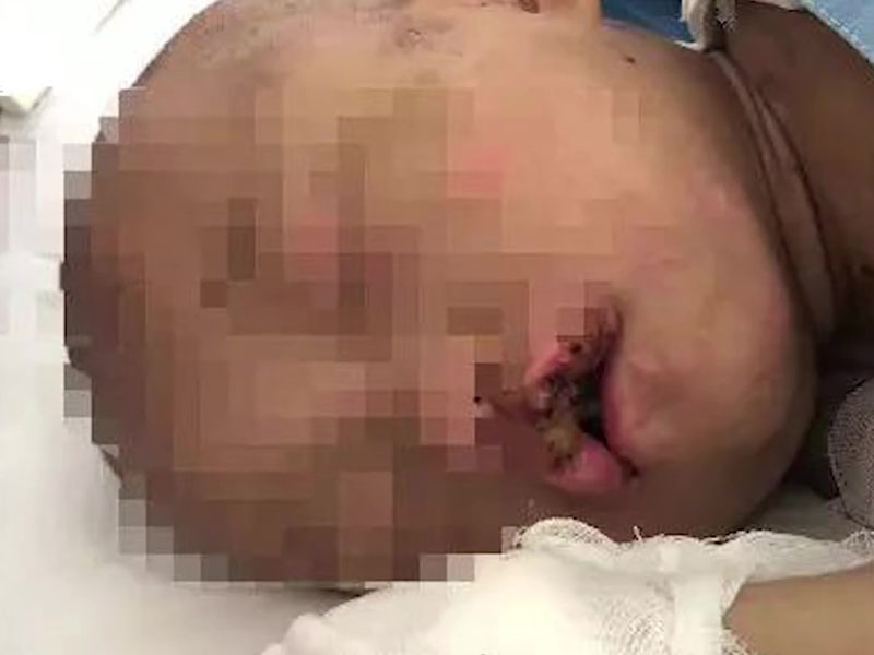 5歲女童遭父母虐打,牙也被打掉的。(網圖)